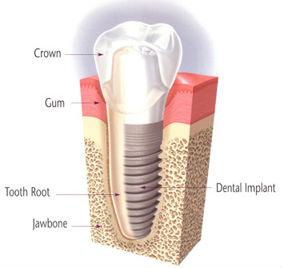 cosmetic-dental-implant_14