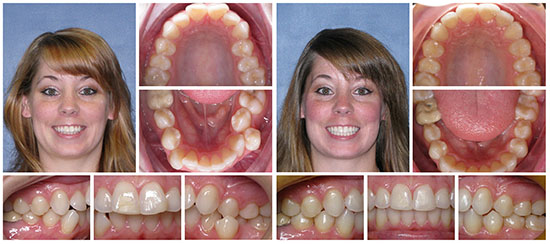 jacksonville_invisalign_before_after_1