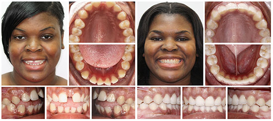 jacksonville_invisalign_before_after_2